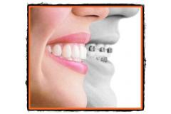 Ortodontia indreptarea si corectarea pozitiei dintilor